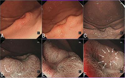 Early hepatoid adenocarcinoma of the stomach with signet ring cell carcinoma: A case report and clinicopathological features